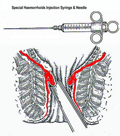 Injection sclerotherapy